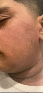 Severe Eczema Healed Naturally 
