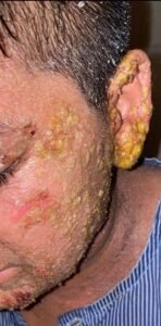 Severe Eczema Healed Naturally 