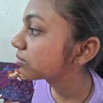 Child with white patches on face before homoeopathic treatment for Pityriasis Alba at Dr. Shweta’s Homoeopathy Clinic, Zirakpur.