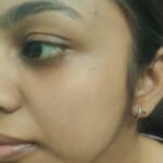 Clear facial skin after homeopathic treatment for Pityriasis Alba at Dr. Shweta’s Homoeopathy Clinic, Zirakpur.