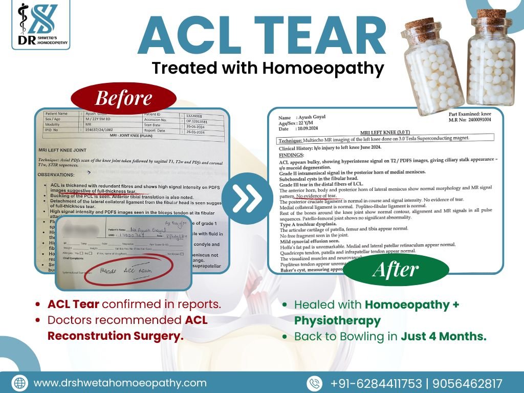 "Young cricketer bowling again after ACL tear recovery through homeopathic treatment at Dr Shweta’s Homeopathy Clinic Zirakpur"